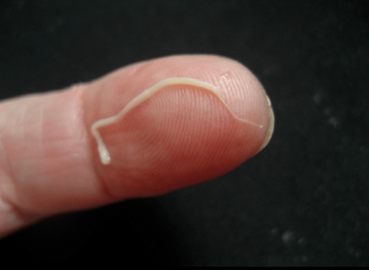 a roundworm parasite of the human body